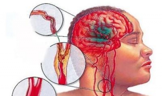脑血栓怎么办 三种治疗方法介绍