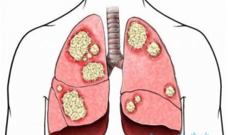 鳞癌和腺癌的区别 这四个区别你知道哪个