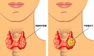 甲状腺结节3级需要手术吗 甲状腺结节3级危险吗
