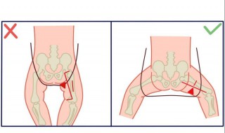 小孩5岁多有些罗圈怎么办 罗圈腿怎么矫正