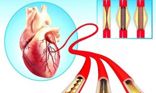 心脏支架术后一个月复查什么 4个时间阶段都不同