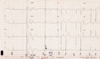 心电图检查梯波低是怎么回事 5大状态