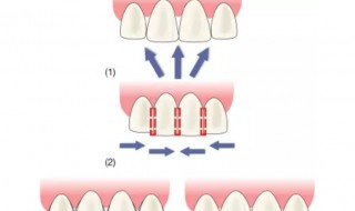 牙齿黑三角如何修复 牙齿为什么会黑三角