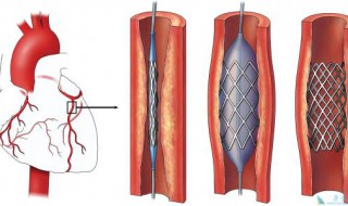 心血管支架病人可以吃氨糖吗 专业回答在这里