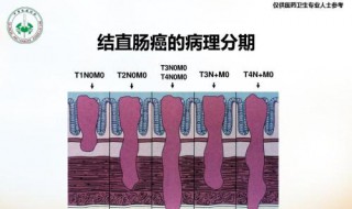 结肠癌二期化疗几次 化疗治疗结肠癌