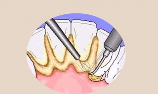 如何让牙结石软化脱落 牙齿上长了牙石怎样清除掉