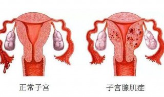 五十岁腺肌症用手术吗 从年龄看不主张手术