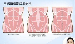 腹部抽脂对女性的危害 健康更重要