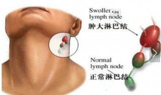 淋巴结严重吗 淋巴结肿大严重吗