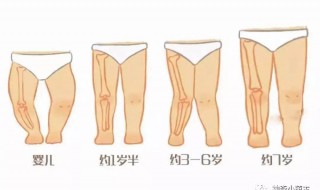 学生0型腿怎么矫正 0型腿的矫正方法