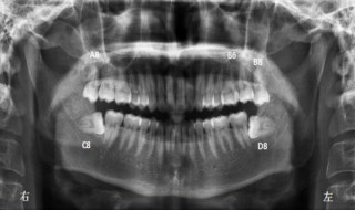 如何判断自己长智齿了 判断自己长智齿的方式简述