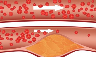 血脂高饮食注意什么 哪些食物应该多吃