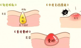 怎样处理青春痘 处理青春痘的方法