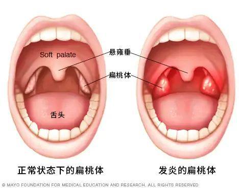 孩子扁桃体老发炎，能不能“割以永治”？